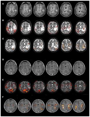 Relation Between Reading Performance and White-Matter Alteration and Reorganization in Neurosurgical Patients